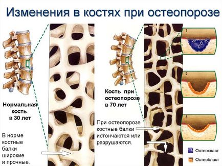 A csontritkulás tünetei és kezelése felnőttek és gyermekek