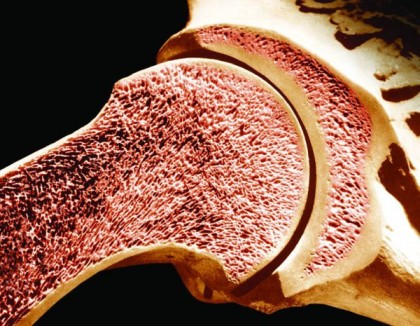 Osteoporoza simptomelor osoase, cauze, tipuri, complicații