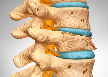 Osteoporoza simptomelor osoase, cauze, tipuri, complicații