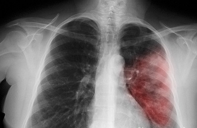 Akut tüdőgyulladás tünetek, jelek és kezelés