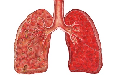 Akut tüdőgyulladás tünetek, jelek és kezelés