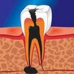 Boala de dinți acută