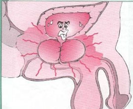 prostatita acută catarală