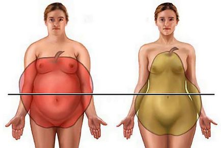 Obezitate sau supraponderalitate