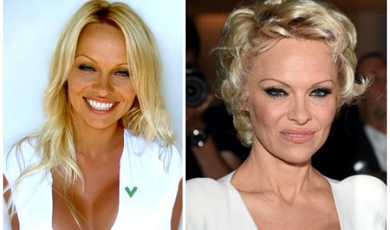 Pamela Anderson előtt és után plasztikai sebészet fotók és videó