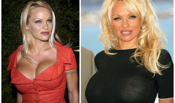 Pamela Anderson înainte și după operații plastice, fotografii și videoclipuri