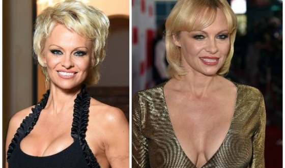 Pamela Anderson előtt és után plasztikai sebészet fotók és videó