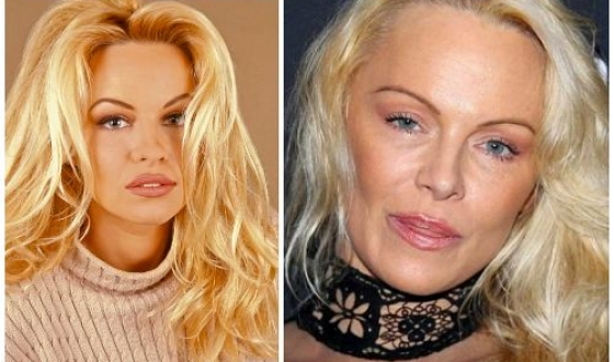 Pamela Anderson előtt és után plasztikai sebészet fotók és videó