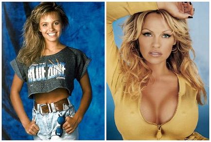 Pamela Anderson előtt és után plasztikai sebészet fotók és videó