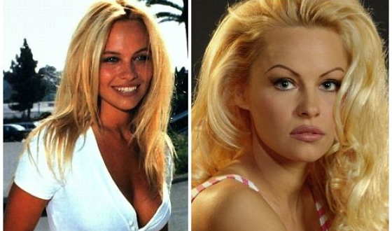 Pamela Anderson előtt és után plasztikai sebészet fotók és videó