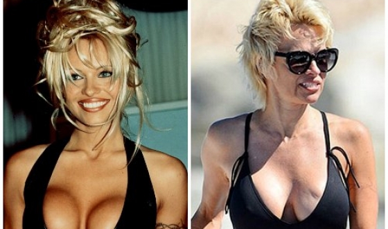 Pamela Anderson înainte și după operații plastice, fotografii și videoclipuri