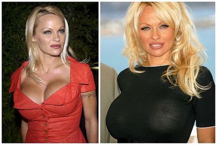 Pamela Anderson előtt és után plasztikai sebészet fotók és videó