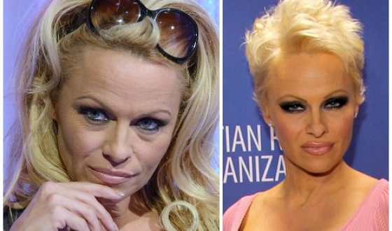 Pamela Anderson előtt és után plasztikai sebészet fotók és videó