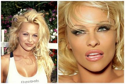 Pamela Anderson előtt és után plasztikai sebészet fotók és videó