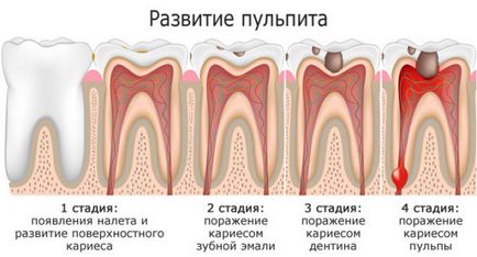 Пенталгін від зубного болю діє після 25-30 хвилин