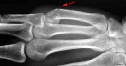 Fractura boxerului (fractura osului metacarpal), traumatologie pentru toti