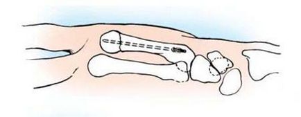 Fractura boxerului (fractura osului metacarpal), traumatologie pentru toti