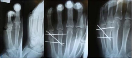 Fractura boxerului (fractura osului metacarpal), traumatologie pentru toti