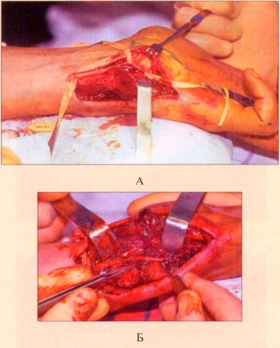 Nerve graft transzplantációs