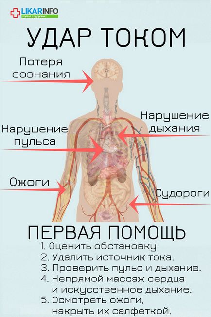 Elsősegélynyújtás áramütés