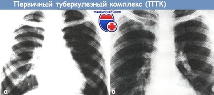 Complexul tuberculozei primare (PTK) - variante, diagnostic