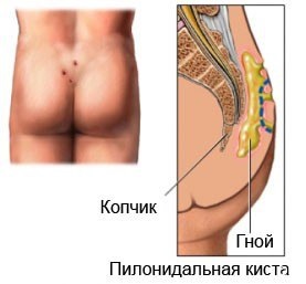 Pilonidális ciszta - a betegség kezelésében