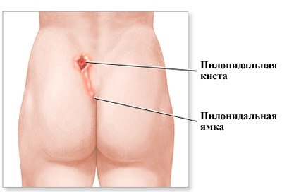 Chistul pilonidal - tratamentul bolii