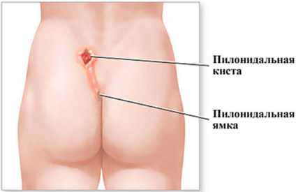 Пілонідальная кіста види, симптоми, лікування, наслідки
