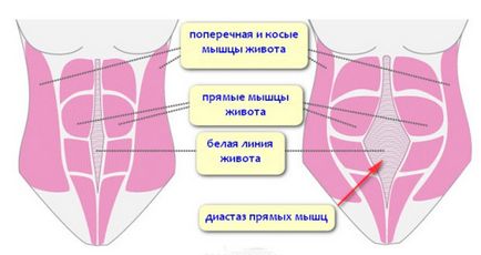 Защо диастаза RECTI и как да го премахнете