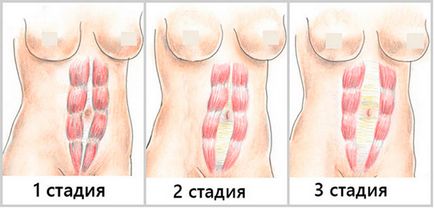 Защо диастаза RECTI и как да го премахнете