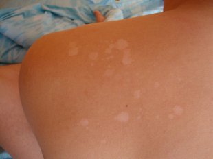 Чому з'являються плями на шкірі після засмаги