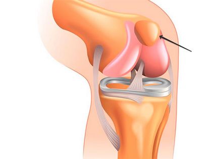 Subluxarea tratamentului cu patella, simptome și reabilitare