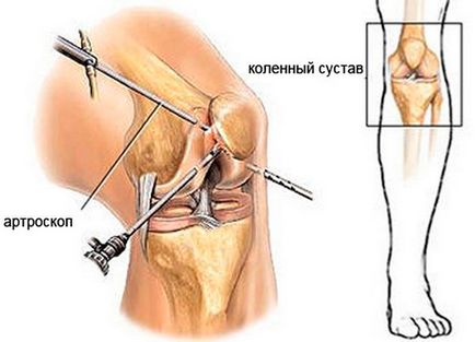 Subluxarea tratamentului cu patella, simptome și reabilitare