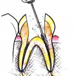 Після пломбування болить зуб при накусиваніі