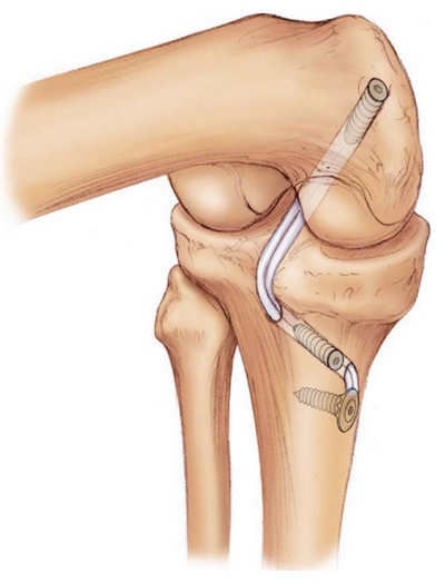 Deteriorările și rupturile ligamentului posterior al crucii sunt