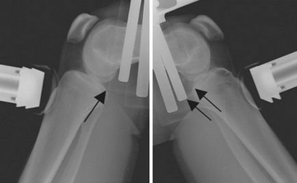 Deteriorările și rupturile ligamentului posterior al crucii sunt