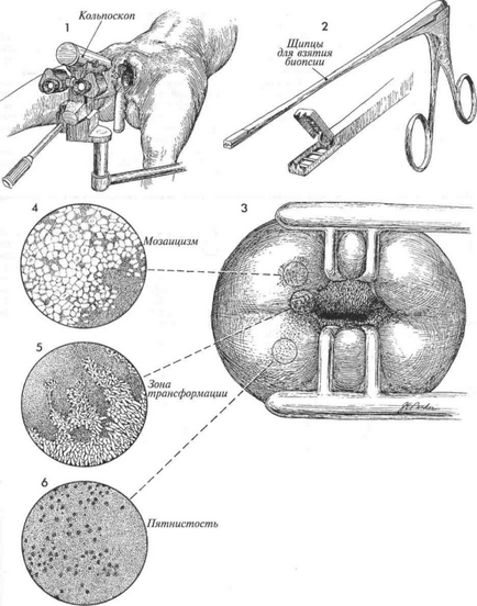 Biopsii vizate ale colului uterin sub controlul colposcopiei