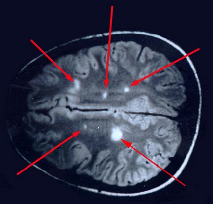 Причини, симптоми і лікування розсіяного склерозу