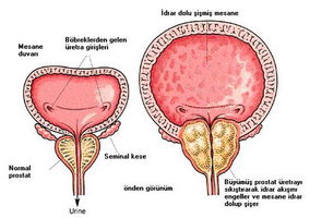 Utilizarea genferonului în diagnosticul de prostatită