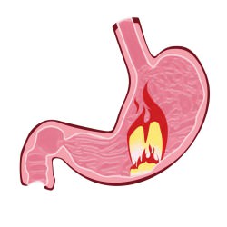 Un ulcer de stomac provoacă simptome și tratament