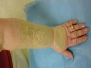 Profilaxia și tratamentul cicatricilor post-ars cu bandaje cu silicon