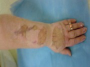 Profilaxia și tratamentul cicatricilor post-ars cu bandaje cu silicon
