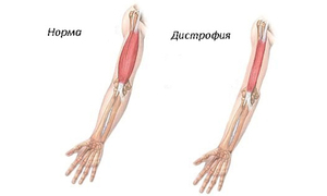 Distrofie musculară progresistă dușenică motive, simptome, tratament și prognosticul bolii