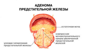 Prostatita și adenomul de prostată - diferențe în cauze, simptome, tratament