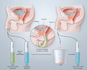 Prostatita și adenomul de prostată - diferențe în cauze, simptome, tratament