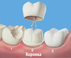 Протезування зубів - симптоми, лікування