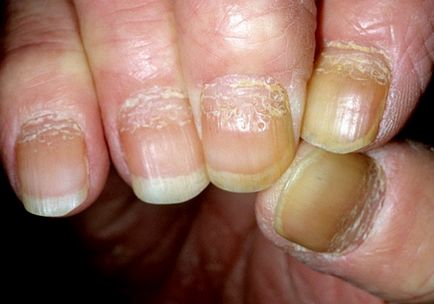 Nail psoriasis okoz, tünetek és fotók
