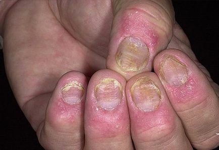 Nail psoriasis okoz, tünetek és fotók