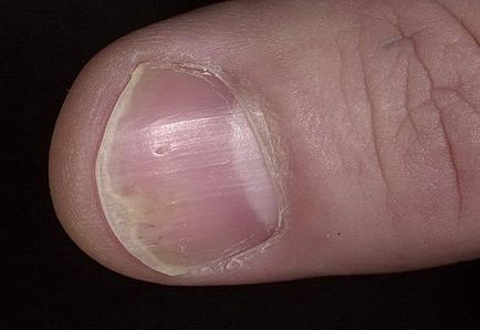 Nail psoriasis okoz, tünetek és fotók