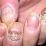 Nail psoriasis okoz, tünetek és fotók